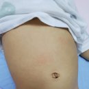 돌된 아기 이유없는 두드러기도 생길수 있나요?ㅠ 이미지
