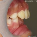 성장기에 잡아야 되는 부정교합 - 과개교합 인비절라인 퍼스트 교정 케이스 평택지제역 치과