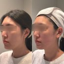 둔산중로-38 | 대전 피부관리｜플로럴스킨 둔산점 싸이블로 리프팅기로 윤곽과 탄력 되찾은 리얼 후기