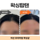 1253헤어 | 배방왁싱 추천! 왁싱탑텐 헤어라인 왁싱 솔직후기