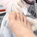 구월동네일 인천레푸스 발톱무좀 후기