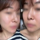 (주)한국줄기세포 | 청담피부과 줄기세포주사 아란셀 후기|내돈내산 킴카다시안 피부 따라잡기 통증 효과