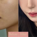 마노성형외과의원 | 인중오목수술 가격, 회복기간, 흉터 정보+병원선택 팁 정리