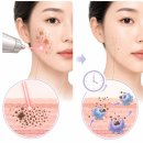 세종문신제거, 몇 번 받으면 다 지워질까요?