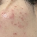 구로 끗한의원 | 구로끗한의원 토닝 3회차(+딱지레이저 2주) 내돈내산 후기