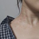 지오 | 드디어 편평사마귀 제거한 후기, 재생 테이프(듀오덤) 접착제 알러지가 곁들여진...