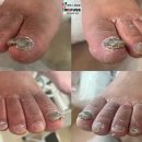 원당 발관리샵 후기) 봉와직염 발톱무좀관리 주의사항은?