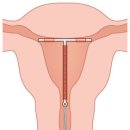 자궁 내 장치[intrauterine device] 이미지