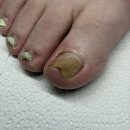 ㈜모두환경 연제지점 | 부산발톱무좀 발톱 자신감 되찾은 후기