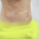 복부거상 했어요~ ^^ (신사역 닥터크리미) 이미지