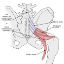 Re: piriformis syndrome 이미지