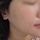 분당-300 | 분당 서현역피부과 텐써마 300샷 고현정리프팅 효과 솔직후기