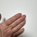 부산 편평사마귀제거 후기 (얼굴, 목, 가슴, 유륜까지)