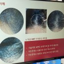 *두피문신필독* SMP가격 SMP부작용 부평두피케어 SMP후기 : 콤마더문 부평점