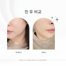 (주)뉴유니버스 | 해운대피부과 슈링크유니버스300샷+사각턱보톡스 후기