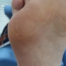 [임산부티눈제거] 연신내 푸스올 내돈내산후기