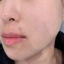 (주)아그네스 | [동탄] 내돈내산 아그네스 5회차 전후비교 및 찐후기/ 가성비 병원 및 바뀐 원장님 추천