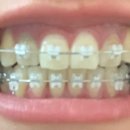 예쁜선치과교정과치과의원 | 치아교정후기_1 :비발치 클리피씨교정 @인천 구월동, 예쁜선치과교정과치과의원