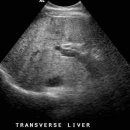 Cirrhosis of the Liver with Portal Hypertension 이미지