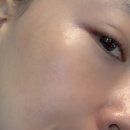 원레이져 | [서울 노원] 시그니처 달빛샤워 레이저 루나크의원 노원역피부과 솔직후기 내돈내산