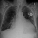 심장 비대[cardiomegaly] 이미지