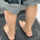 OPTIMAL NATURE | 레푸스 상도점, 수술후 재발한 아이 내성발톱 관리 가격