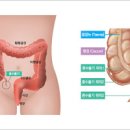 맹장염 초기 증상 급성만성위치 이미지