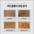 서면 여드름흉터자국 제거 시 우선으로 둬야 할 치료 방법은?