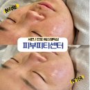 서면 에스테틱 파메스테틱 전문인증샵 피부피티센터 부산서면센터 세멘시트 관리 후기 + 화잘먹