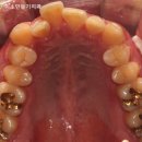 아름다운차이치과의원 | 40대 치아교정 부작용, 잇몸이 더 약해질까요? 안산 본오동 치과 실제 사례