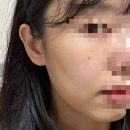 오가멍 | [신부관리] 쥬베룩 볼륨 3회 후기! 옆볼 꺼짐, 땅콩형얼굴 , 볼패임 극복기(멍, 효과없는 부위 후기)