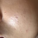 율한의원 | 분당여드름흉터 패인흉터 한의원 새살침 율각테라피 솔직 후기 전후사진