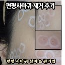 실비가 | 내돈내산 편평사마귀 레이저 제거 후기 / 실비 보험 청구부터 관리까지 완벽 정리