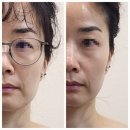 루원시티피부관리 &#39;바로 REMEDY 루원시티점&#39;에서 동안 두피리프팅 받았어요