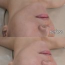 항가령피부연구소 | 얼굴 끌어올려어↗, 울산웨딩관리 온다리프팅 '노진희피부연구소'