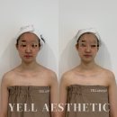 올라오니 | 대구웨딩관리 수성구웨딩관리 옐에스테틱 무통증 3V윤곽관리 V업리프팅 후기