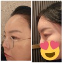 이마 | 서면 피부과 이마필러 5cc 솔직 후기!!