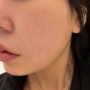 홍대전철역 KT옆 | 홍대 피부과 홍대리프팅 튠페이스 효과 후기