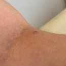 오체안피부과의원 | 피부과 CO2 레이저로 안 빠지던 팔 섬유종, 결국 성형외과 수술로 해결_오체안성형외과 신사