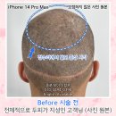 종로-연건-종로-연-231 | [20대 남성 탈모 삭발문신] 종로남자두피문신 후기 2/2
