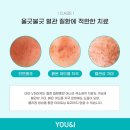 안면가스 이미지
