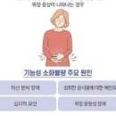 기능성 소화불량 이미지