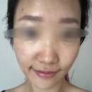 피어리움의원 | 양주 옥정동 피어리움 _결혼 전 피부관리 후기_리쥬란힐러