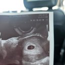 이정래산부인과의원 | 이정래산부인과 후기 임신5주~11주 졸업까지의 초음파 사진 비교