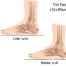 족저근막염증상과 치료방법 이미지