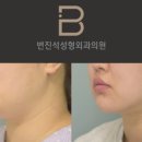 변진석성형외과의원 네이버블로그