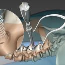 척추 유합술 이미지