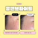 레푸스MS | 춘천 후평동 레푸스 후평점 샵인샵 영앤브라이트에서 기미, 잡티, 주근깨, 점 제거 레이저