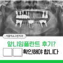 강인호치과의원 | 앞니임플란트후기 ‘이것’을 확인하지 않으면 후회하는 이유