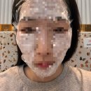 리쥬란 힐러 주사 솔직 후기💉 | 맞은 다음날 상태는?